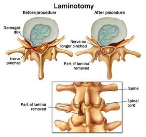 laminotomy-cervical-surgery